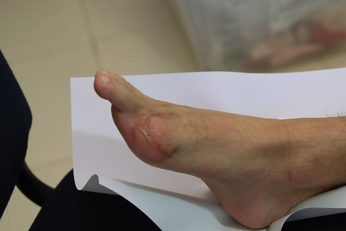 protesis dedo del pie